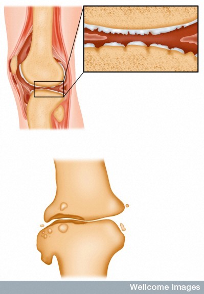 osteoartrite