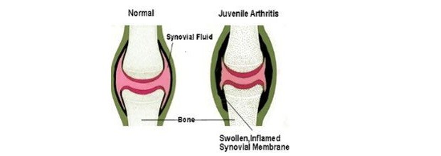 Artrite giovanile, sintomi iniziali