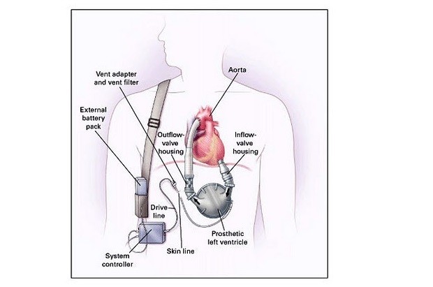 LVAD, sistema di assistenza ventricolare