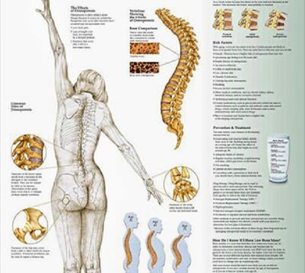 osteoporosi