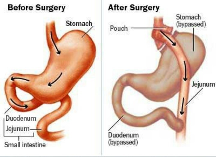 Bypass gastrico, costi