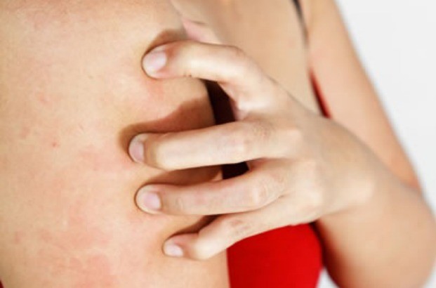 Orticaria: cause, sintomi e rimedi