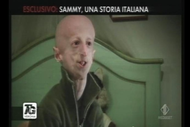 Sammy Basso Progeria