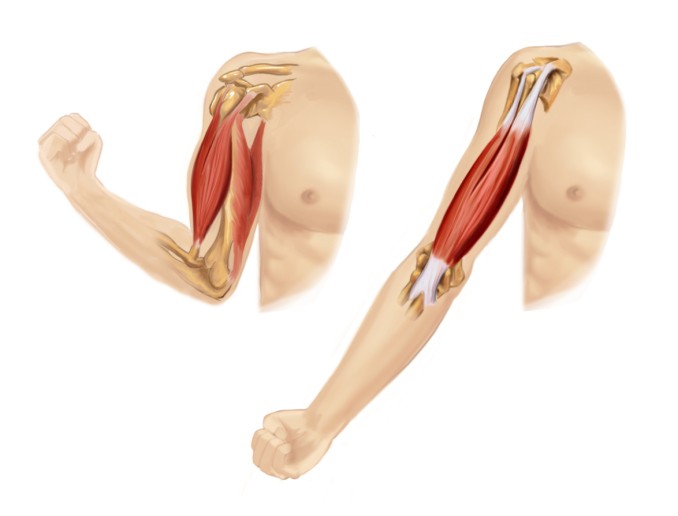 sarcopenia