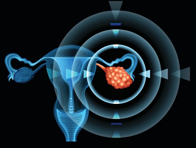 meccanismi metastasi ovaio