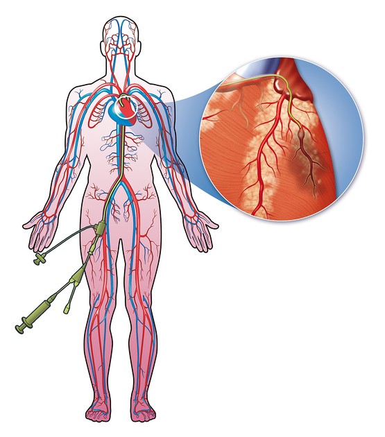 Infarto del miocardio