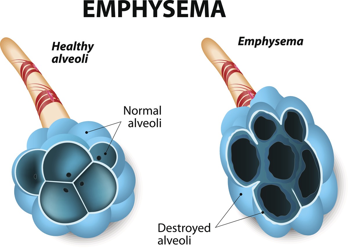 Enfisema