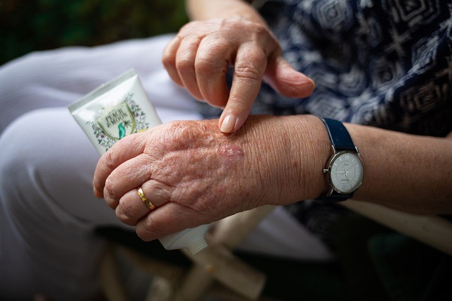 Lupus: sintomi della malattia e le cure possibili