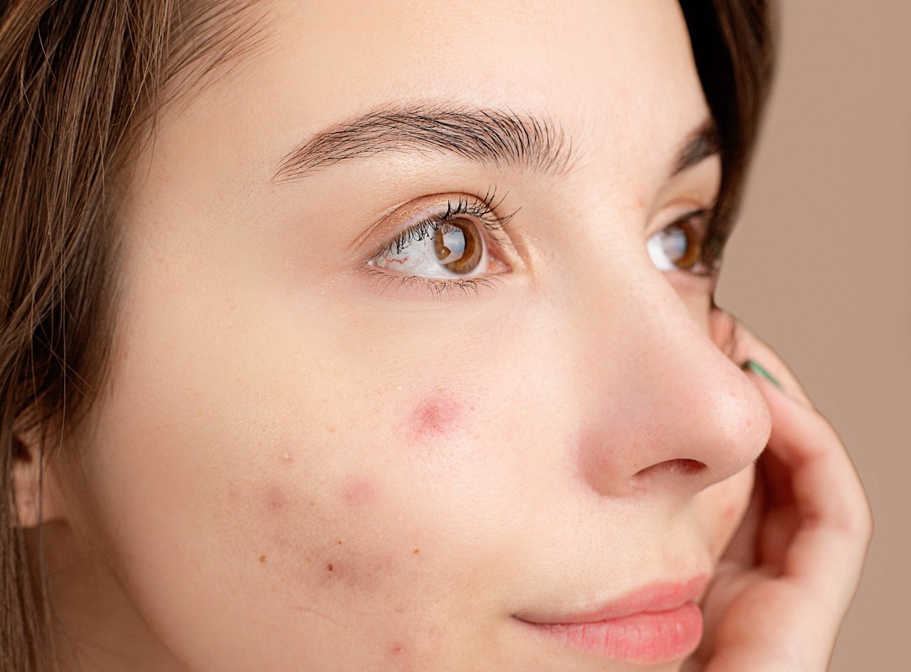 Acne cistica sintomi e cause