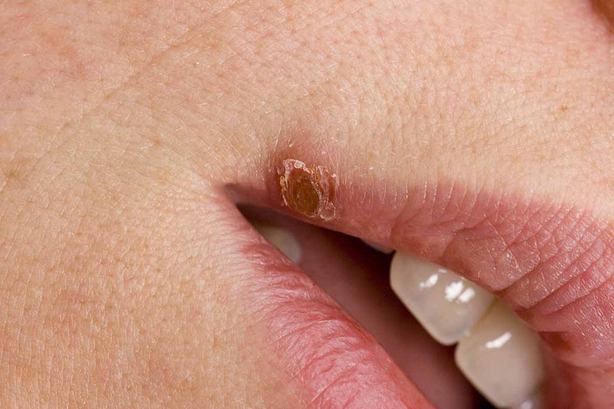 Herpes labiale in gravidanza: cosa usare